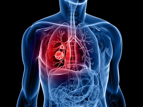 Lungekreft: forventet levetid